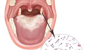 Bệnh bạch hầu là gì? Nguyên nhân, triệu chứng, cách phòng tránh hiệu quả nhất